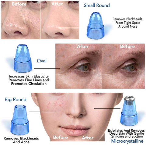 Blackhead
