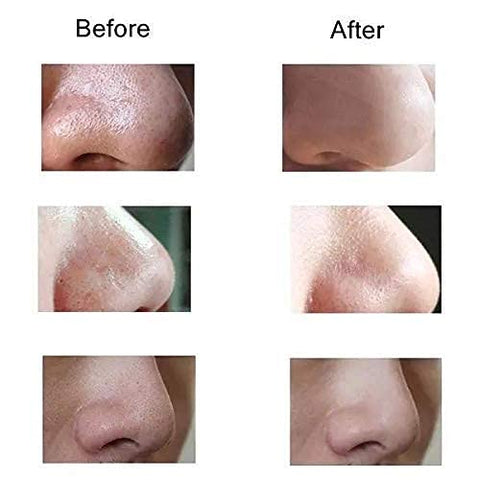 Blackhead